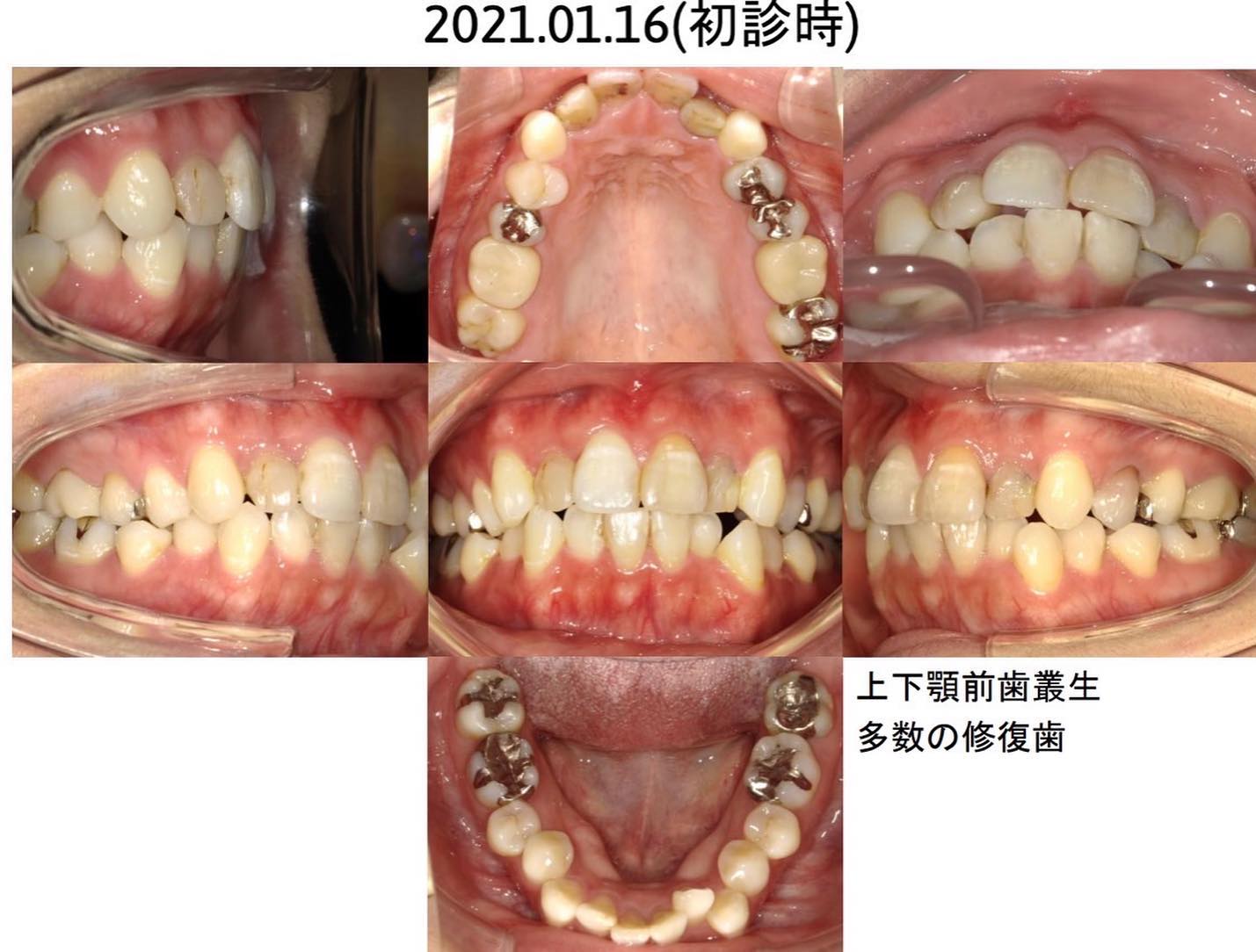 インビザライン
歯科矯正
専門医による矯正治療