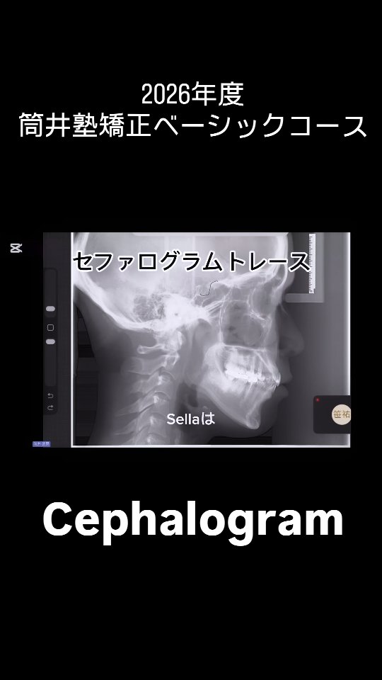 ◯筒井塾矯正ベーシックコース 一日目
セファログラムについての講義動画になります。
受講された先生は筒井塾ホームページよりフル動画をご覧になって下さい。
来月もまた宜しくお願い致します!