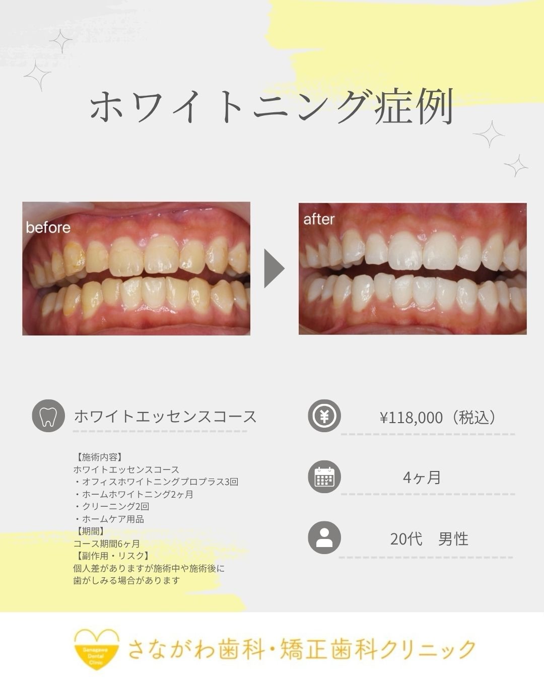 ホワイトニング症